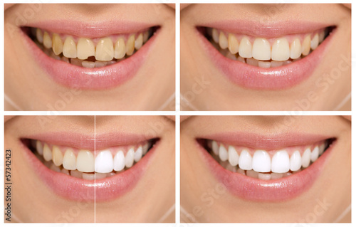 Teeth decay cure. Tooth whitening. Before and after. #57342423