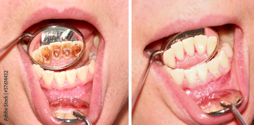 Before and after removal of tartar