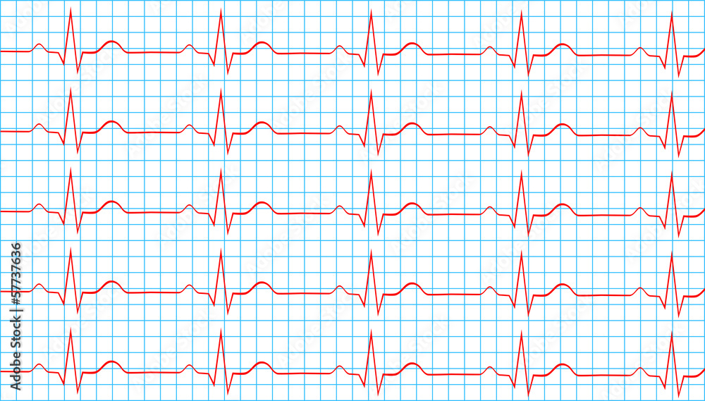 Naklejka premium Heart Normal Sinus Rhythm On Electrocardiogram Record
