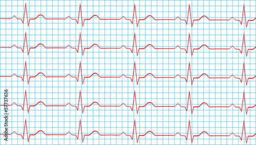 Heart Normal Sinus Rhythm On Electrocardiogram Record