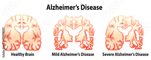 Alzheimer's Disease