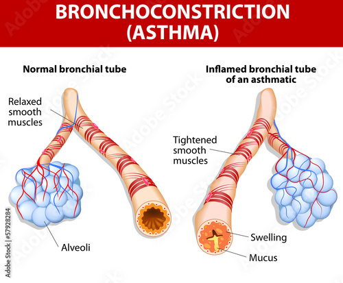 inflamation of the bronchus causing asthma photo