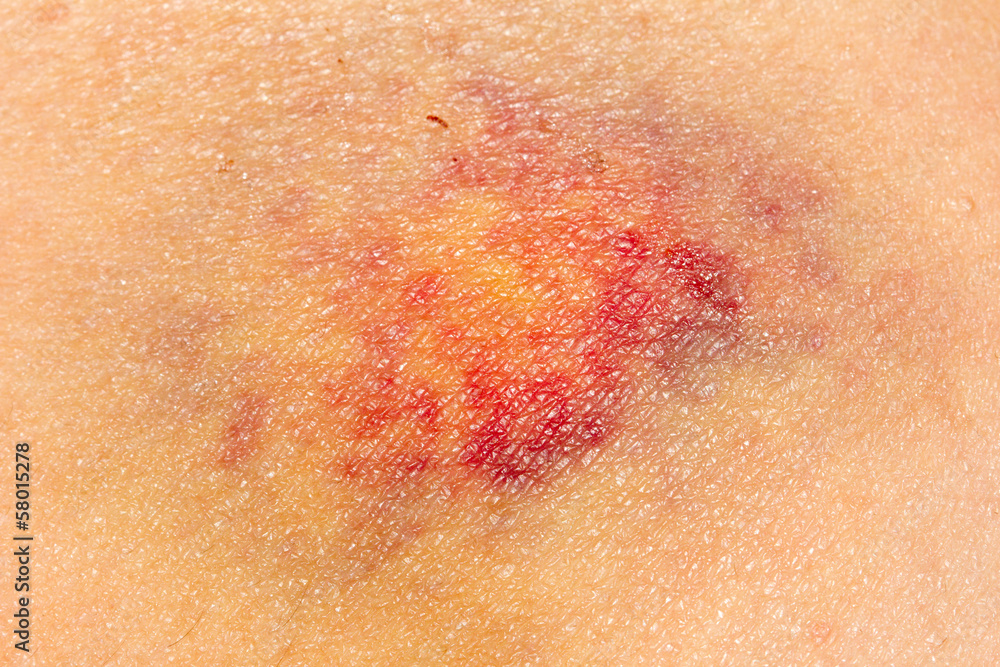 Fototapeta premium Nasty looking bruise on hip, macro shot