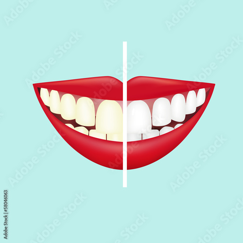 Before and after view of teeth whitening