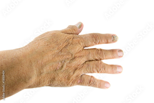 nail detachment  of old woman's finger