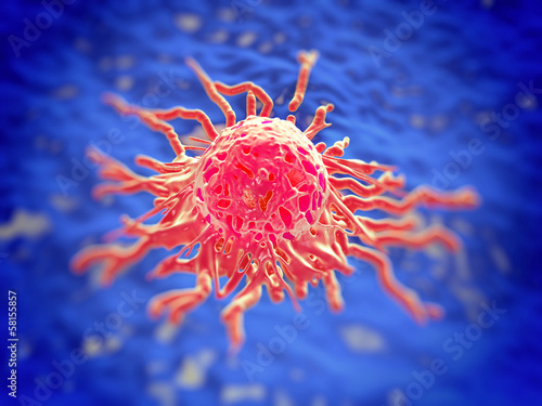 Cervical cancer cell, SEM of Cervical Carcinoma photo