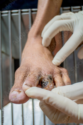 Diabetic ulcers at the foot