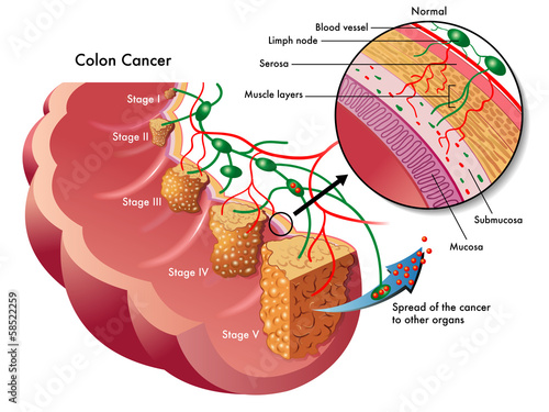 cancro del colon photo