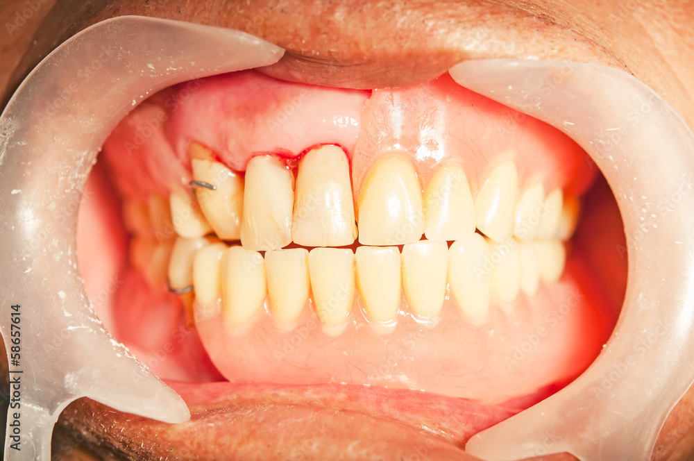 Obraz premium Dental prosthesis for upper denture in mouth.