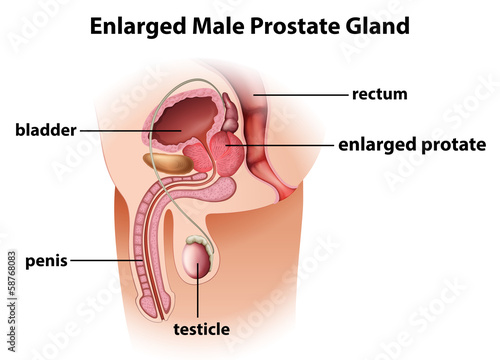 Enlarged male prostate gland photo