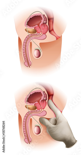 Prostate Cancer