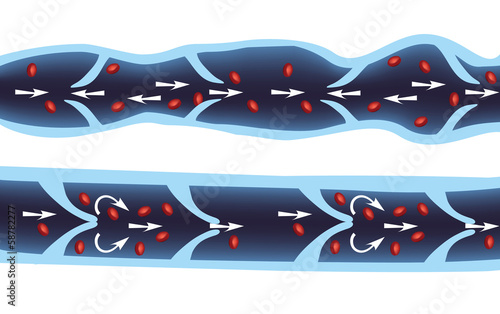 Normal vein and varicose vein