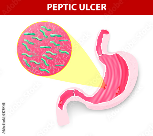 Peptic ulcer