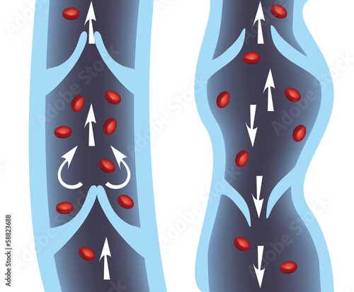 Veins. Normal vein and varicose vein.