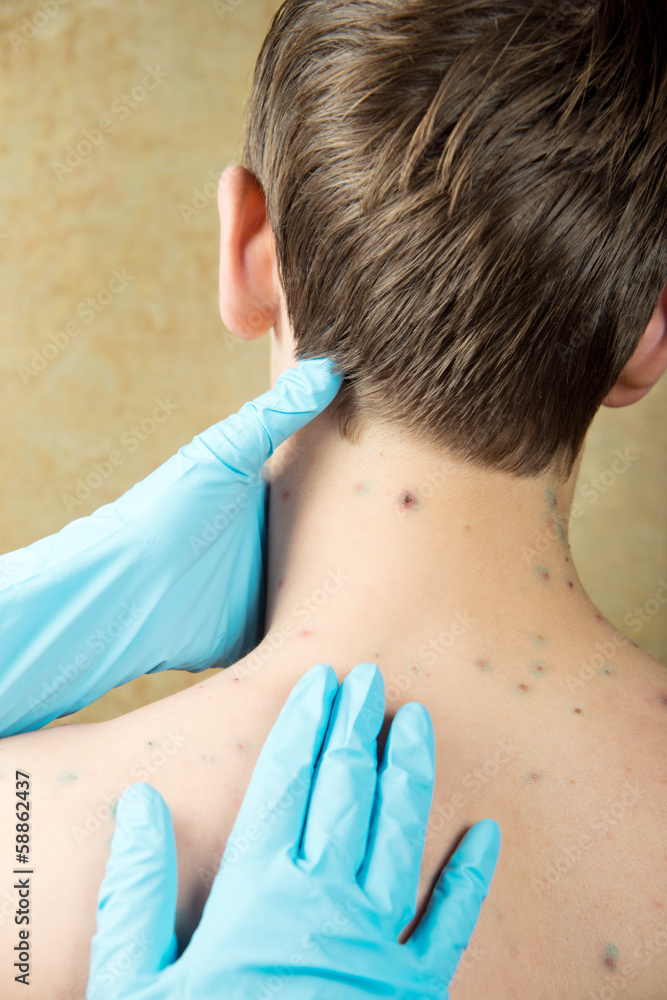 Chinelpocks Rash Chickenpox. Skin rash. Viral disease. Stock Photo | Adobe Stock