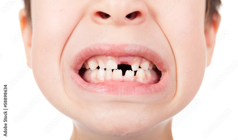 Fototapeta premium Boy portrait with a lost tooth