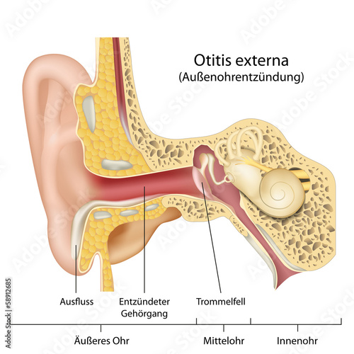 Otitis externa Ohr Krankheit