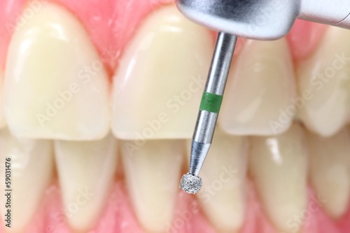 Zahnarztbohrer vor Zahnmodell