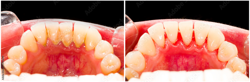 Fotografia Plaque Removal