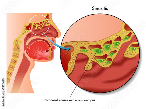sinusite