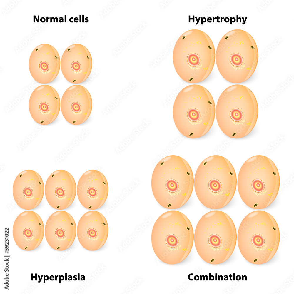 difference hyperplasia, hypertrophy and normal cells Stock Vector ...