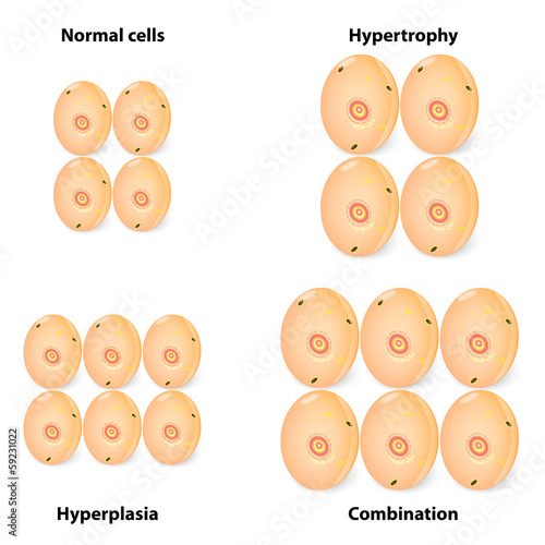difference hyperplasia, hypertrophy and normal cells