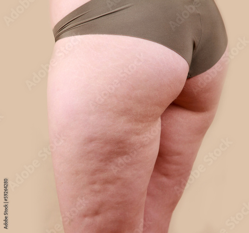 Cellulite skin at woman thighs