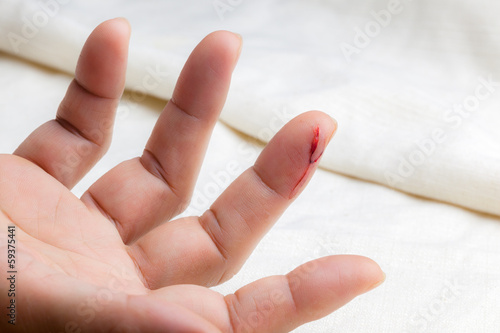 Φωτογραφία Injured finger with bleeding open cut