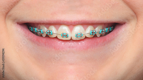 Close up smile with orthodontic braces.