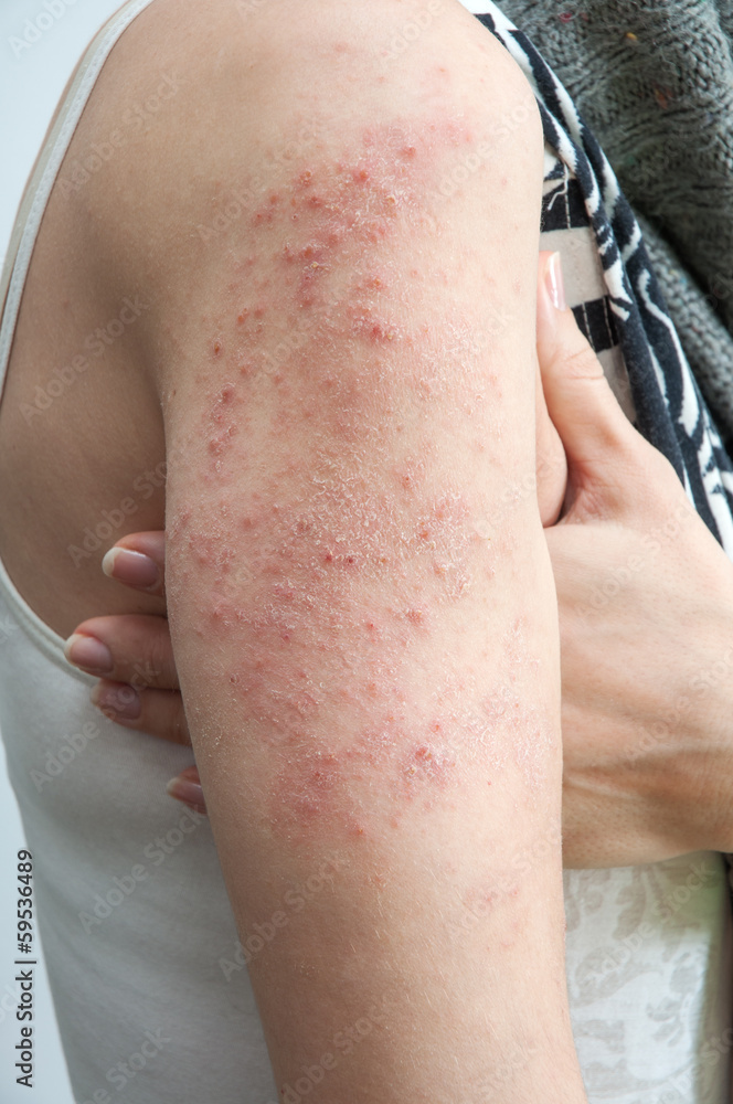 Naklejka premium allergic rash dermatitis