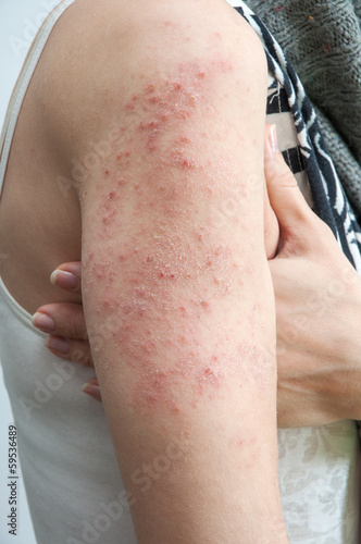 allergic rash dermatitis