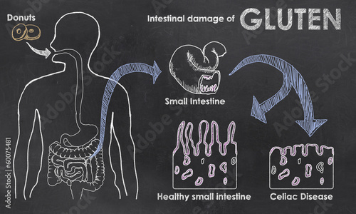 Intestinal Damage of Gluten