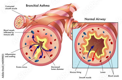 asma bronchiale photo