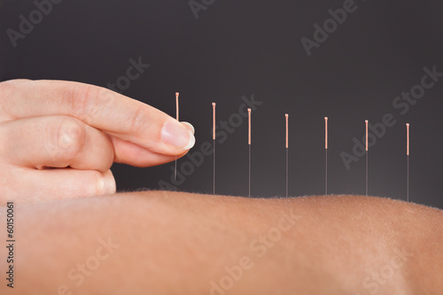 Fototapeta Naklejka Na Ścianę i Meble -  Acupuncture Treatment