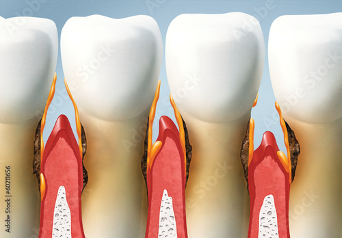 treat your teeth, periodontal