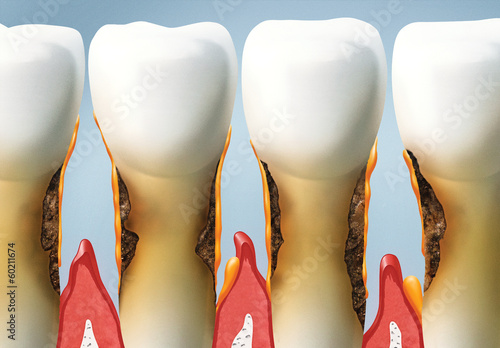 Canvastavla treat your teeth, periodontal