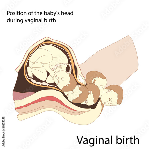 Vaginal birth