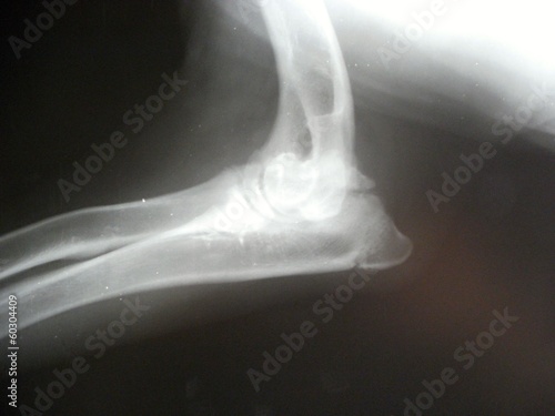 Elbow - ununited processus anconeus by dog