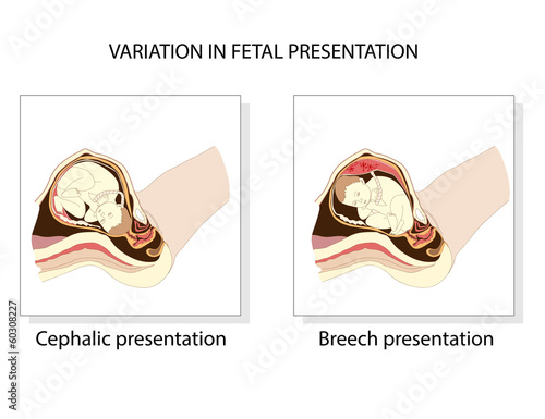Variation in  fetal presentation.  Pregnancy