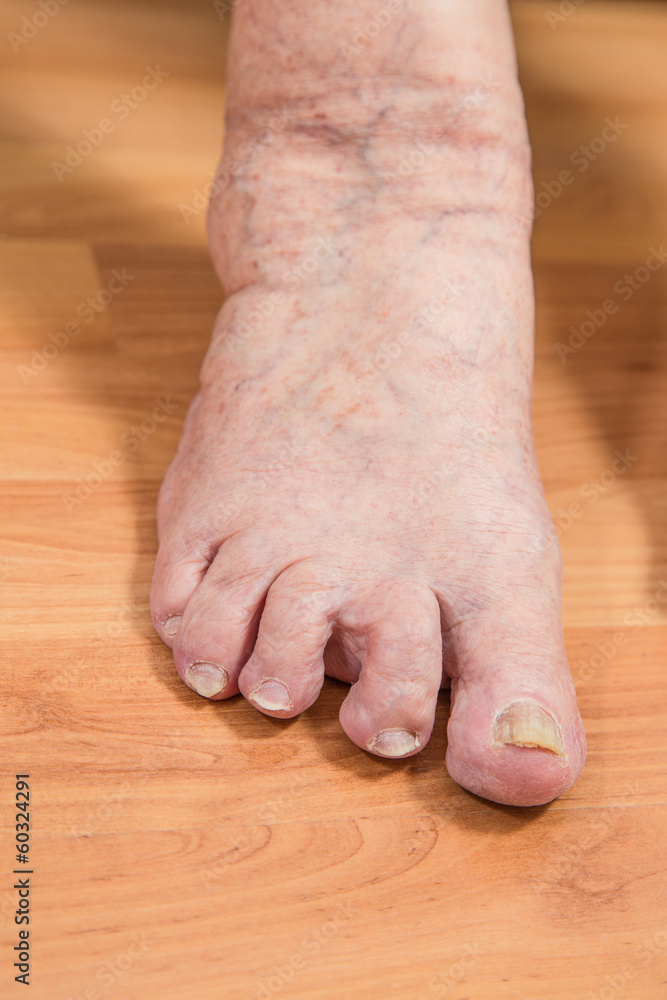 damaged toes of a senior person