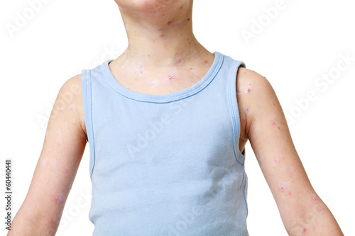 Little boy with chickenpox