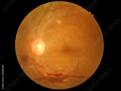 retinal of diabatic retinophaty photo