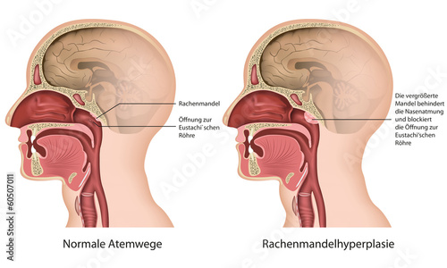 Rachenmandelhyperplasie, adenoide verformung deutsch
