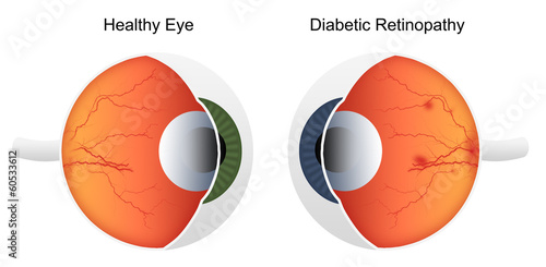 Fototapeta Naklejka Na Ścianę i Meble -  Comparison of health eye vs eye affected by diabetic retinopathy