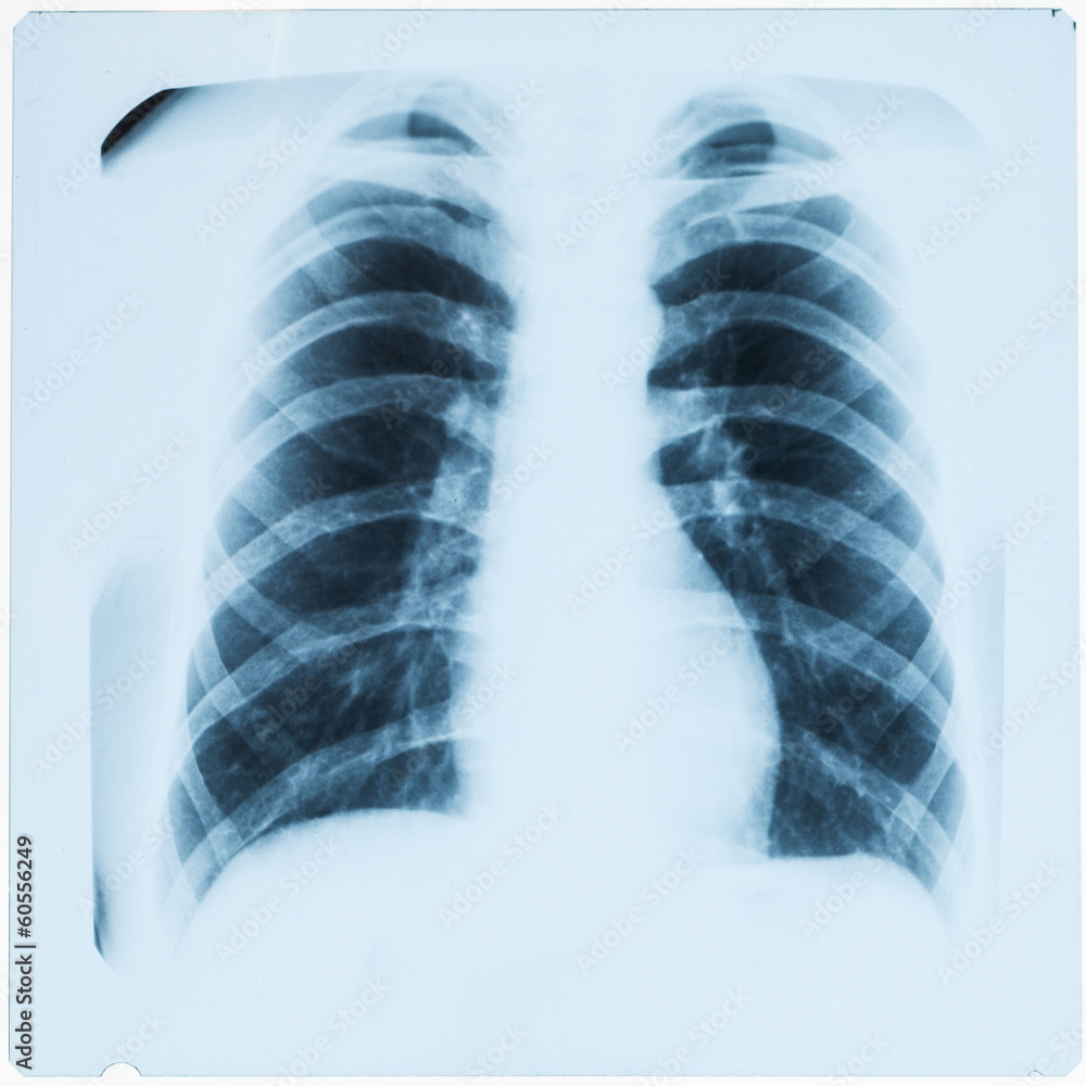 X-ray of man's chest after pneumonia X-ray of man's chest after pneumonia