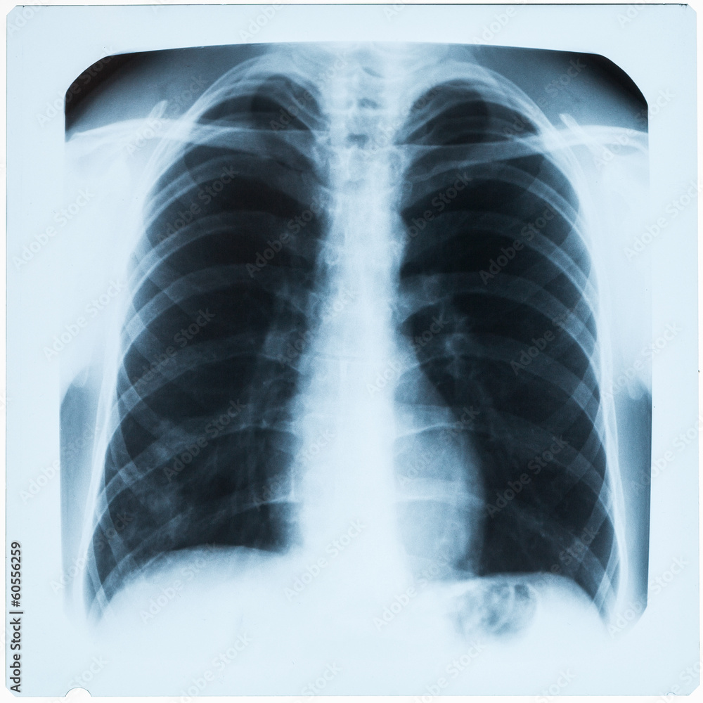 X-ray of man's chest during pneumonia X-ray of man's chest during pneumonia