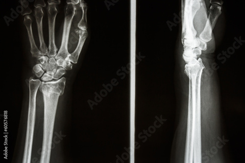 Colles' fracture photo