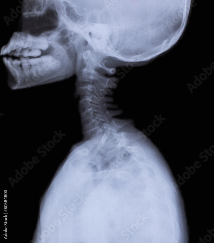 detail of neck and head x-ray image photo