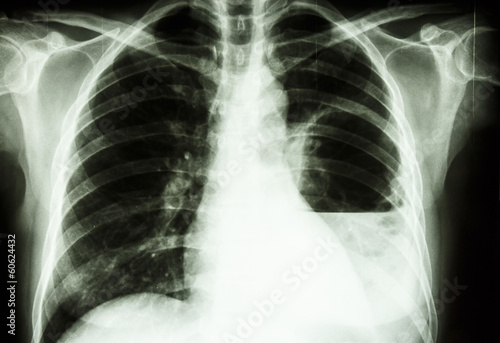 Billede på lærred lung abscess