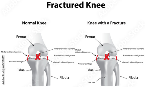 Fractured Knee